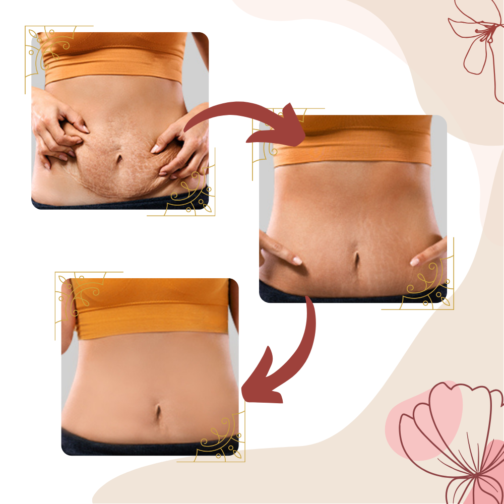 Masseur anti-cellulite par vibrations à haute fréquence
 - Ozerty