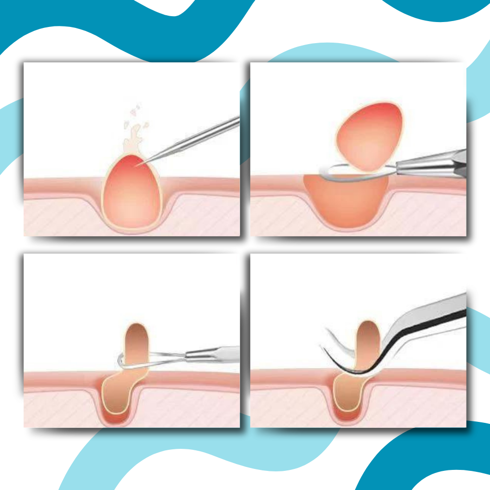 Pinces de précision pour points noirs - Ozerty