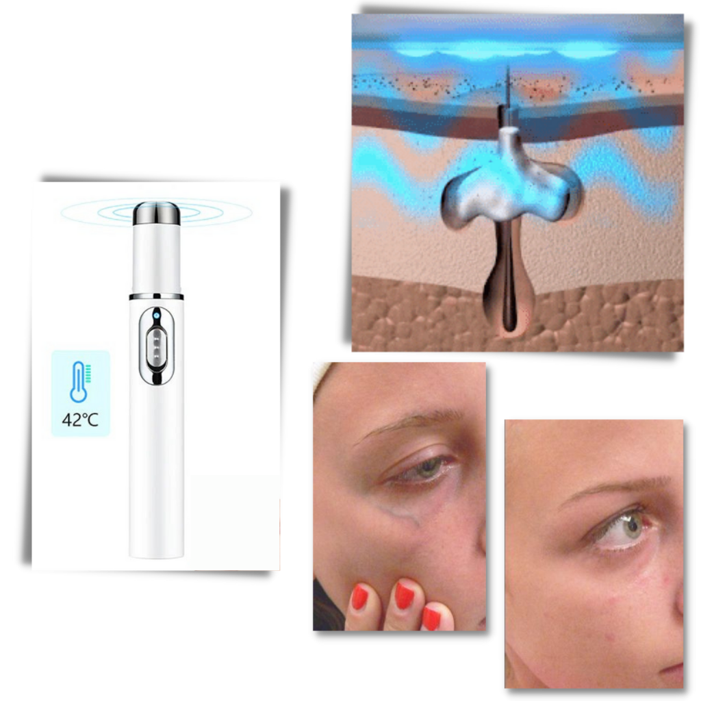 Stylo de thérapie de la peau à la lumière bleue - Ozerty