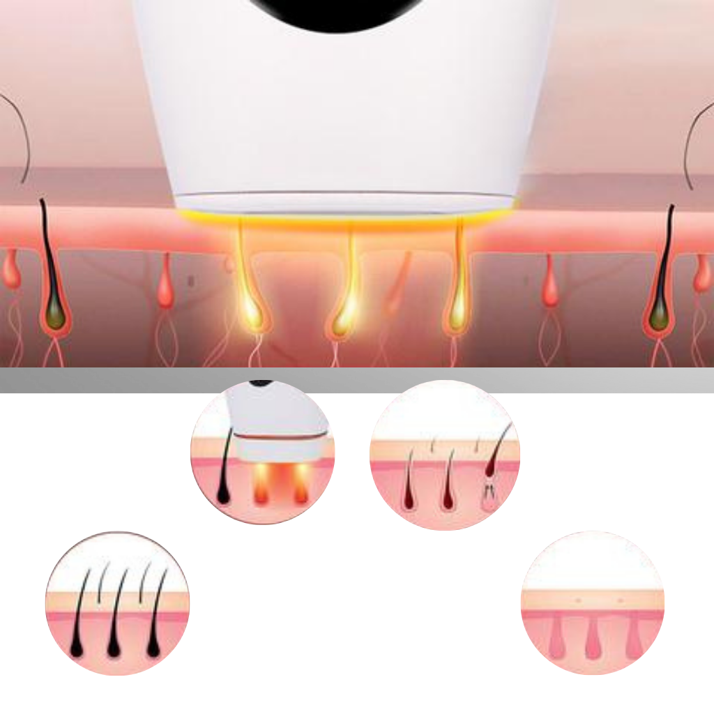 Appareil d'épilation laser IPL - Ozerty