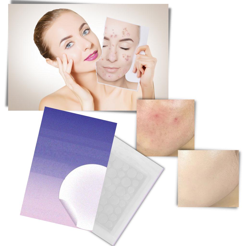 Pack de 36 patchs invisibles contre l'acné - Ozerty