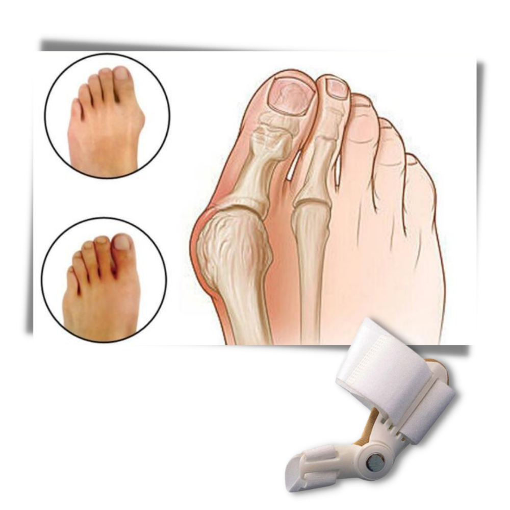 Correcteur d'oignon au pied orthopédique  - Ozerty